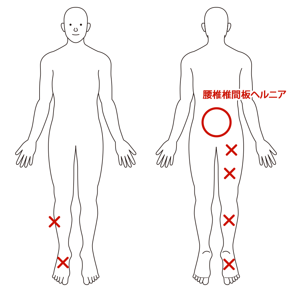 腰椎椎間板ヘルニア