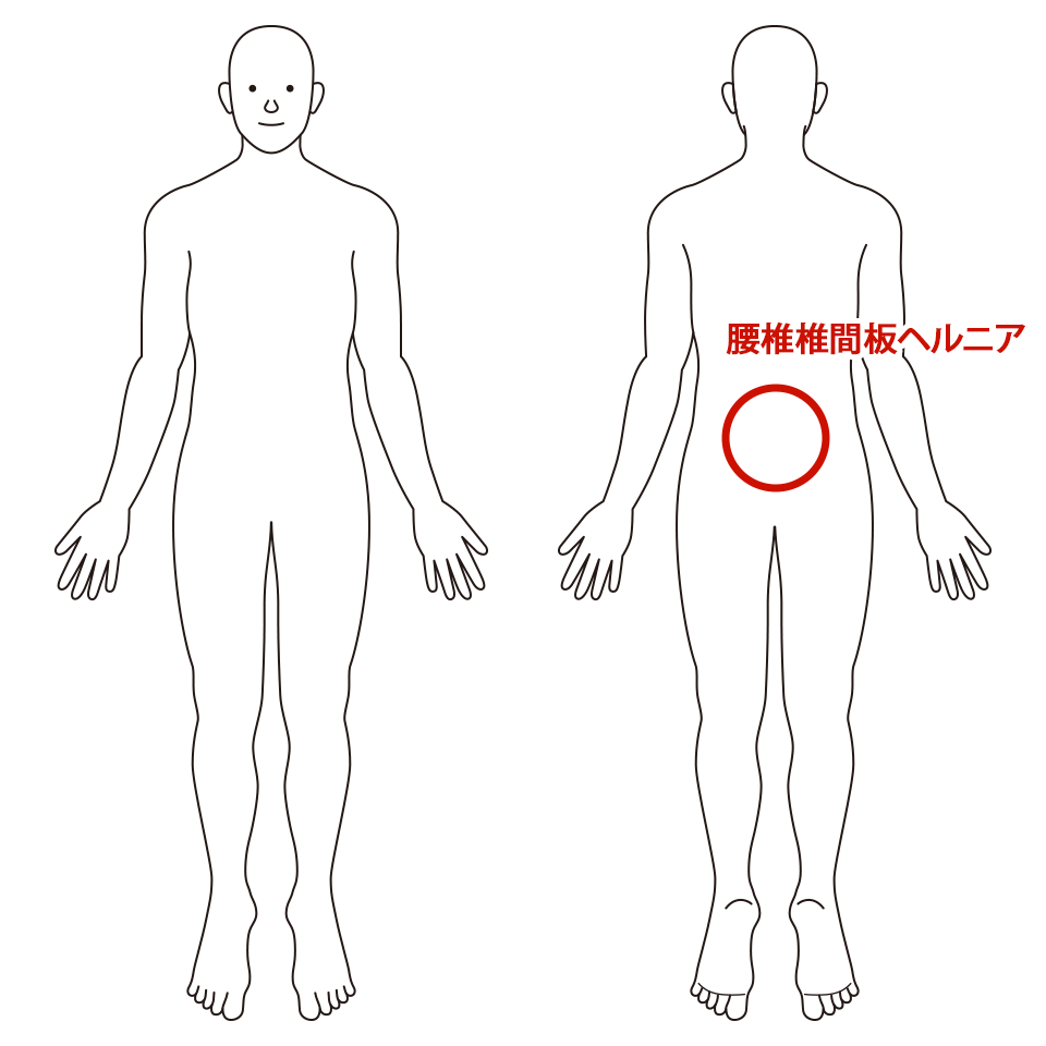 腰椎椎間板ヘルニア
