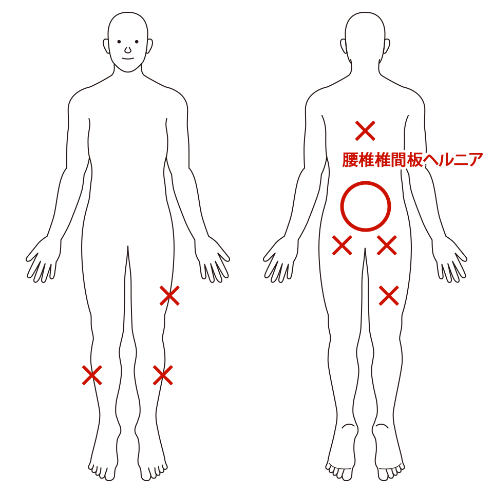 腰椎椎間板ヘルニア