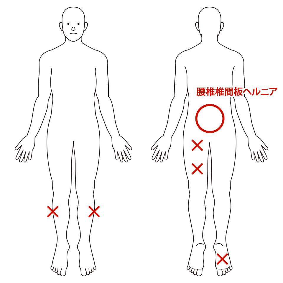 腰椎椎間板ヘルニア