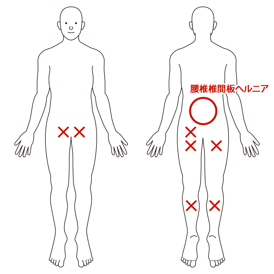 腰椎椎間板ヘルニア