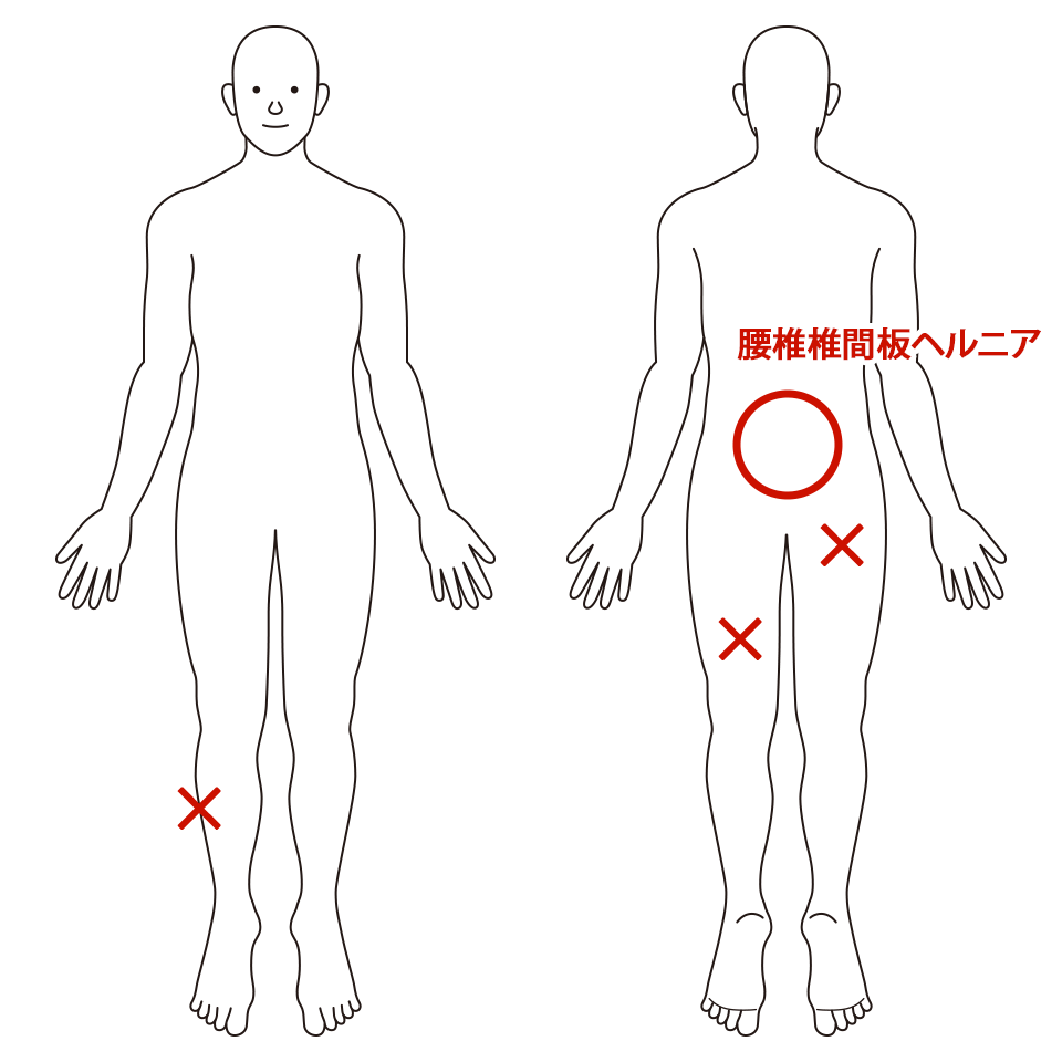 腰椎椎間板ヘルニア